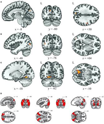 Altered Functional Connectivity and Sensory Processing in Blepharospasm and Hemifacial Spasm: Coexistence and Difference